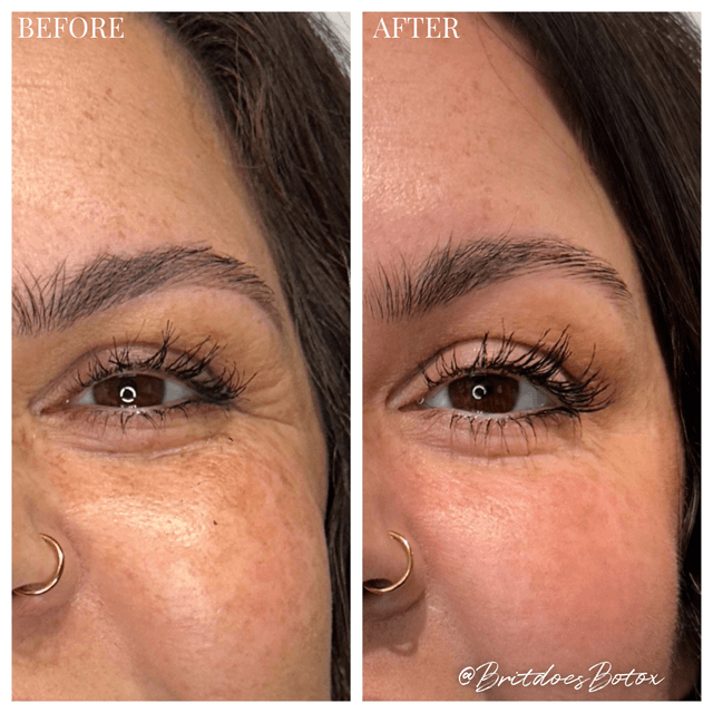 Botox dysport before and after