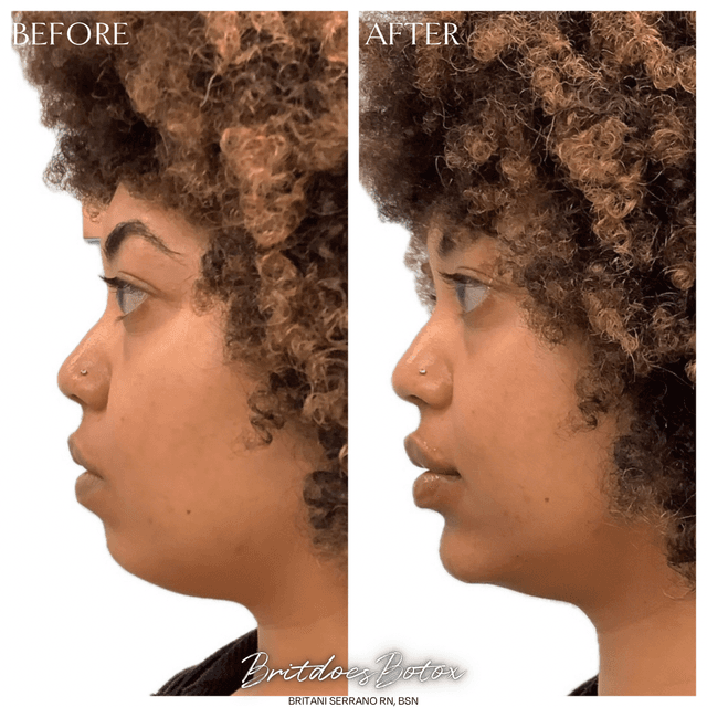 Side profile glow up with natural jawline and chin filler. Always here for balanced, refined results.