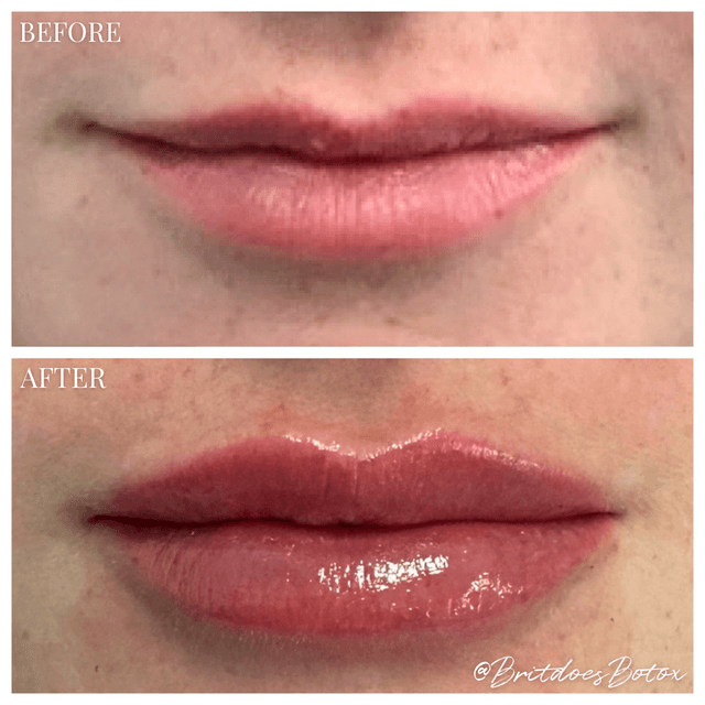 Lip filler injection before and after