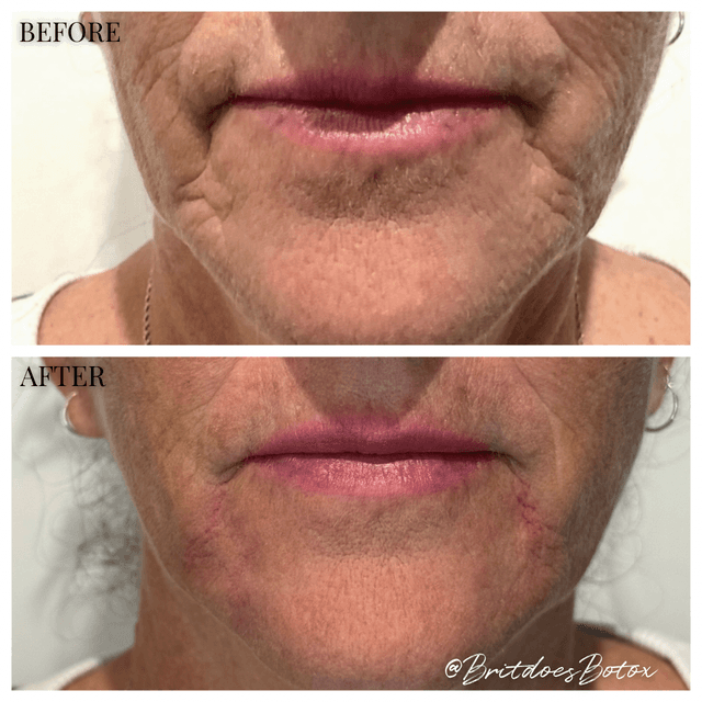Lower face before and after