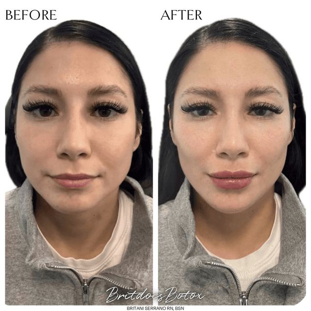 Full face filler rejuvenation results before and after