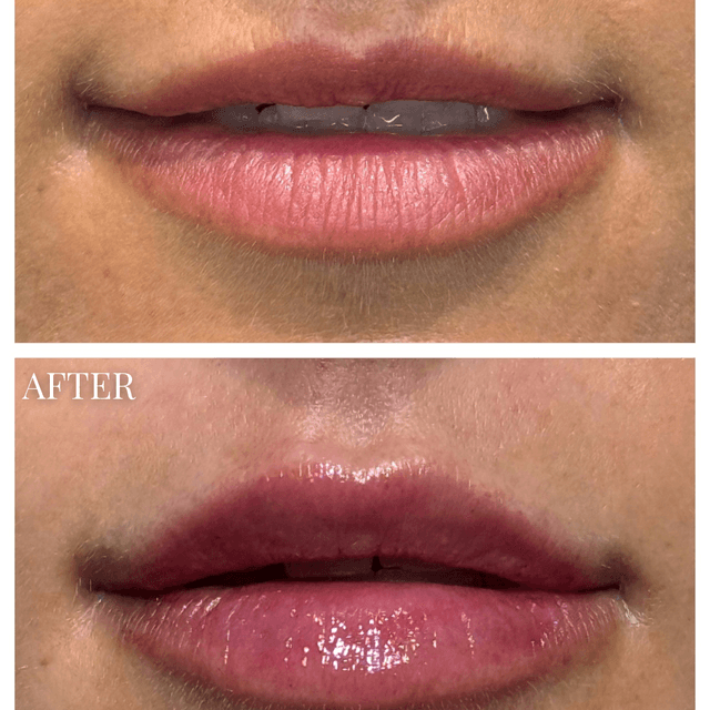 Lip filler injection before and after
