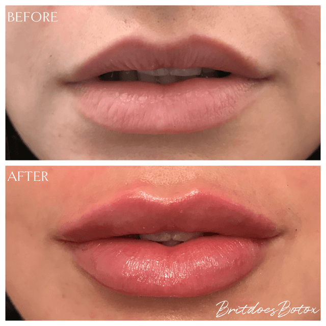 Lip filler injection before and after