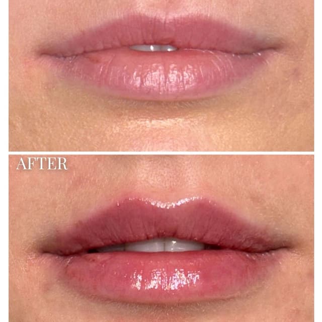 Lip filler injection before and after